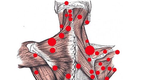 Pontos-gatilho em músculos que provocam dor miofascial nas costas