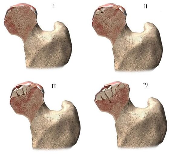 estágios de artrose da articulação do quadril