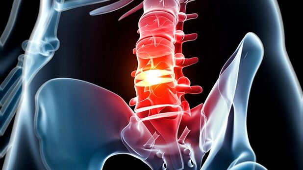osteocondrose da coluna lombar