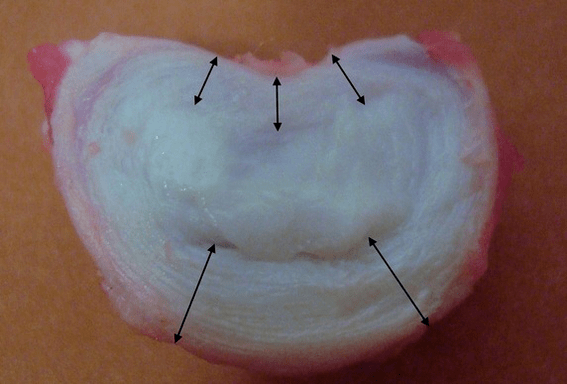 como é um disco intervertebral
