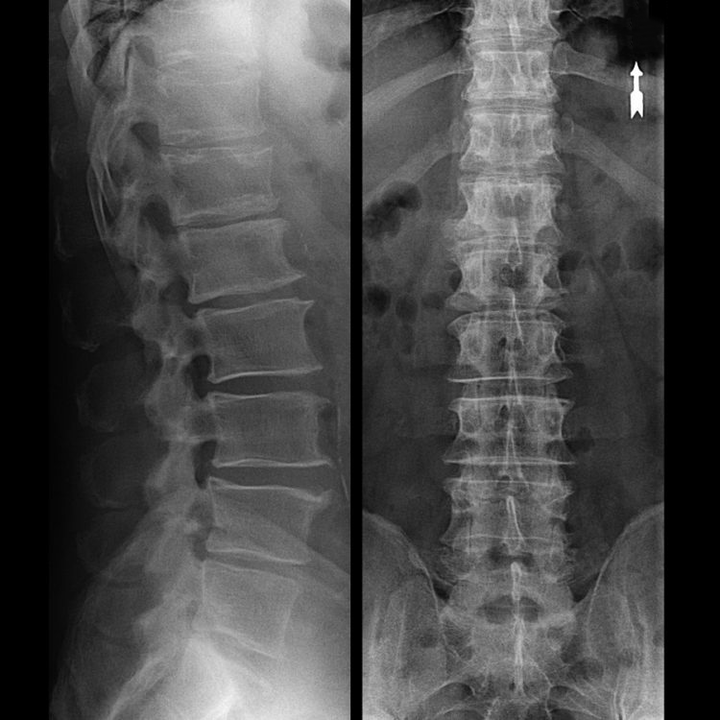 osteocondrose da região vertebral na radiografia