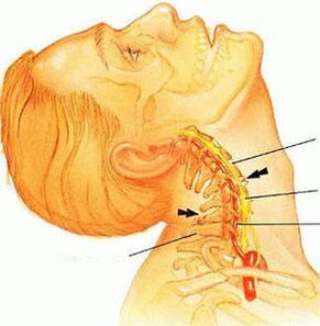 Osteocondrose da coluna cervical