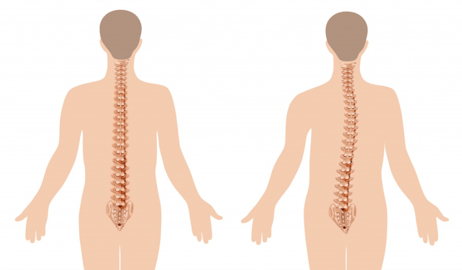 manifestação de osteocondrose
