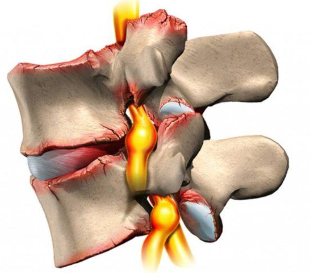 Osteocondrose da coluna vertebral